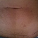 Lines drawn for a full skin-only TT lines drawn by PS during initial consultation.