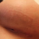 Small hole where Dr opened the incision to drain. Notice the black in the hole..yeah, that's the implant. Not happy at all.