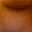 post op morning day 2 - close up inframammary incision
