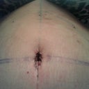 Belly Button...3 days PO