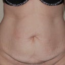pre-op pic front view