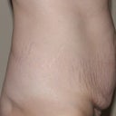 pre-op side view