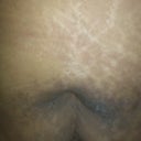this is the rash that I get from my belts because my stomach hangs over