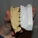 Difference in top arch before and after Six Month Smiles, RUINED.