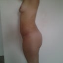 16 days post op side view