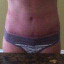 9 weeks 2 days, scar. I kind of like it?? It's so low, and not as bad as I was expecting. Vertical doesn't bother me.