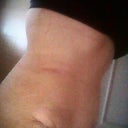 You can see my ribs...first time since surgery 21 days PO (3 weeks)