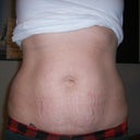Front view pre-op tummy tuck
