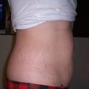 Side pre-op tummy tuck