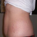Other side pre-op tummy tuck