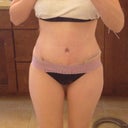 2 weeks postop
