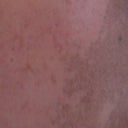92hrs left side - you can see that the dead skin has not completely peeled off yet. yuck!