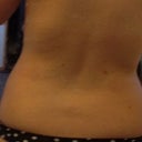 Back 4-weeks post-procedure