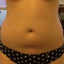 Front - 4-weeks post-procedure
