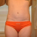 1 Year PO front showing scar