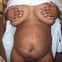 the day of surgery with the markings on my stomach