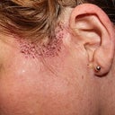 Hair transplant performed 6-months after revision surgery to further camouflage scars from botched surgery at Renaissance Surgical Clinic. Cost of hair transplant $5,000 plus travel.