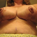 Day 1: bilateral breast