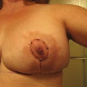 Day 1: Left breast