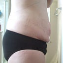 16 hours post op. I'm very swollen and the lose skin hasn't attached back to the muscle yet.