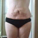 16 hours post op. I'm very swollen and the lose skin hasn't attached back to the muscle yet.