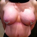 Day 8 Post Op, Allergan HP Natrelle Saline 350cc Left/Right, Filled to 360cc.