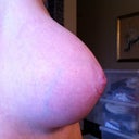 Day 38 Post Op, Right Breast Side View