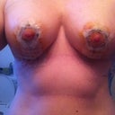 4 day post op
