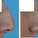 The profile morph Dr. Shah made. The one for the front looked mostly the same other than straightening out of the nose, and he said that it was hard to show the differences via morph, so I left it out.