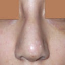A picture of the crazy swelling I was having the night following cast removal. Flash is unforgiving, so I'm sure that only served to make it look worse than it might have actually been, but I wanted to share with you all how extreme the swelling can be. It does go away!