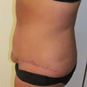8 weeks, scar and swollen VJ, OMG it is still so puffy and swollen, looks much better covered up!