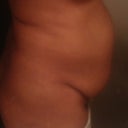 Day before surgery.