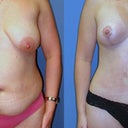 Before surgery and 1 month after. You can tell my left was my 'superboob' - the one that made the most milk and therefore the babies preferred it!  Marks on either side of belly button are from surgical tape.