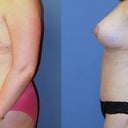 It's a pleasure to go w/out a bra at night now! Still have swelling in tummy, but it's not uncomfortable or anything.