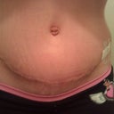 close up bb n incision 18 days