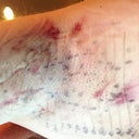 Day After Procedure