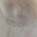 Three Weeks Post-Procedure