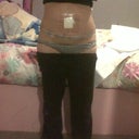 THIS IS 5 DAYS PO!! STILL SWOLLEN BUT IM OK W THAT