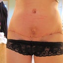 2 weeks post-op!  Surgical tape came off today!