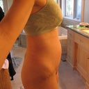 2 weeks post-op side-view.  Pic taken late in day- swollen and bloated but no bulge!
