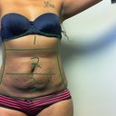 taken at a consult. UGGGGGGGGGH THE LOOSE SKINNNNNNN