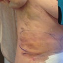 Bruises.