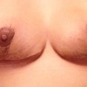One month post op-looking a lot better :)