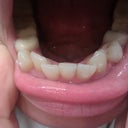 Bottom teeth - Tray#1; severe crowding
