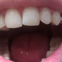 Top teeth- Tray#1; minor crowding but there is a gap on the left side that should be closed with an implant by the end of the Invisalign treatment