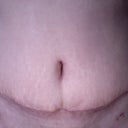 My scar, one month post-op