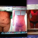 pre-surgery and 9 mons post op (1st surgery)