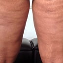 About one and a half months post op bruising and swelling totally gone