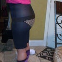 side view about 2 days post op