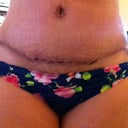 1 week post op.